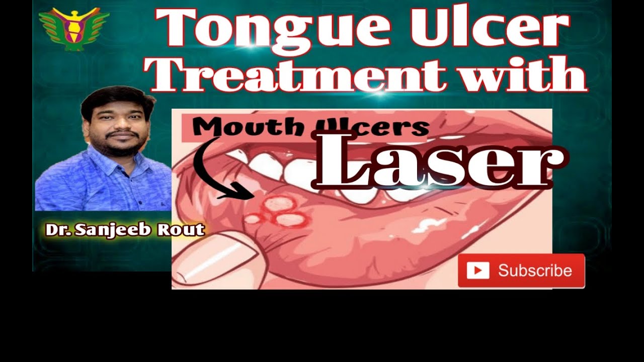 Tongue ulcer Treatment with Laser// Dr. Sanjeeb Rout // Balaji skin and