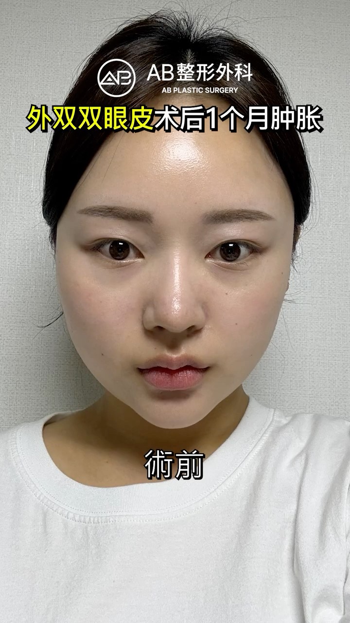 眼整形後變得更漂亮了✨ #Shorts