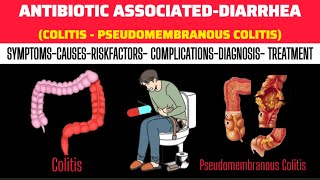 Diarrhea - Antibiotic-Associated Diarrhea - Symptoms - Causes - Risk Factors - Diagnosis - Treatment Do Antibiotics Cause Diarrhea