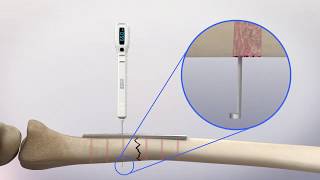EDG® Ortho 65mm Universal Digital Depth Gauge by EDGe Surgical, Inc.