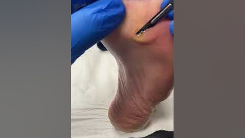 Expert Podiatrist Uses Scalpel to Remove Large Forefoot Corn in Australia