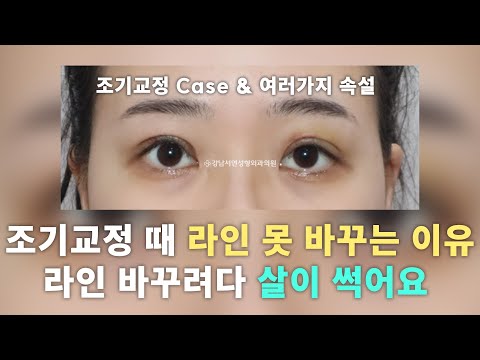 성형탐구 I 조기교정 때 라인 못 바꾸는 이유 라인 바꾸려다 살이 썩어요