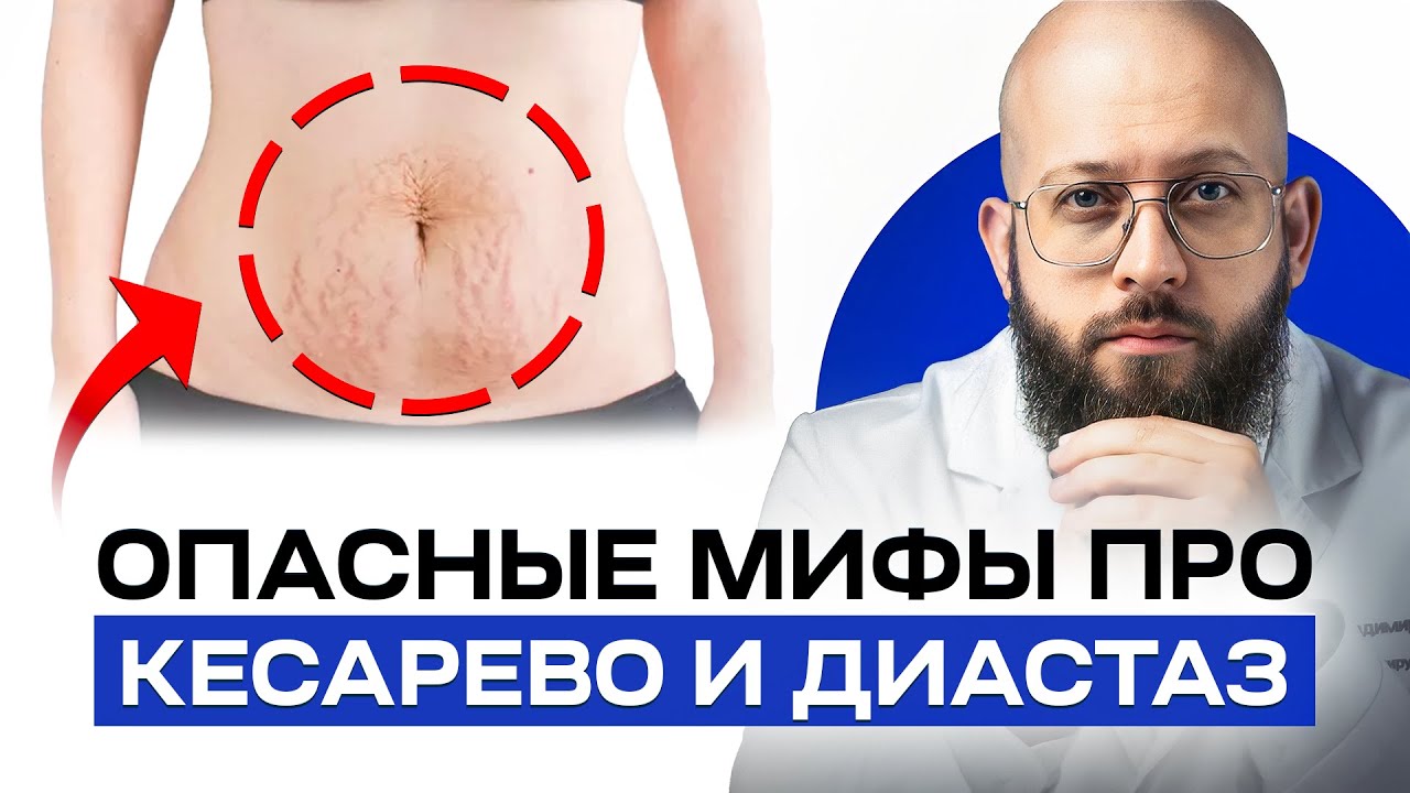 Бывает ли диастаз после кесарево сечения? Когда нужно лечить диастаз ...
