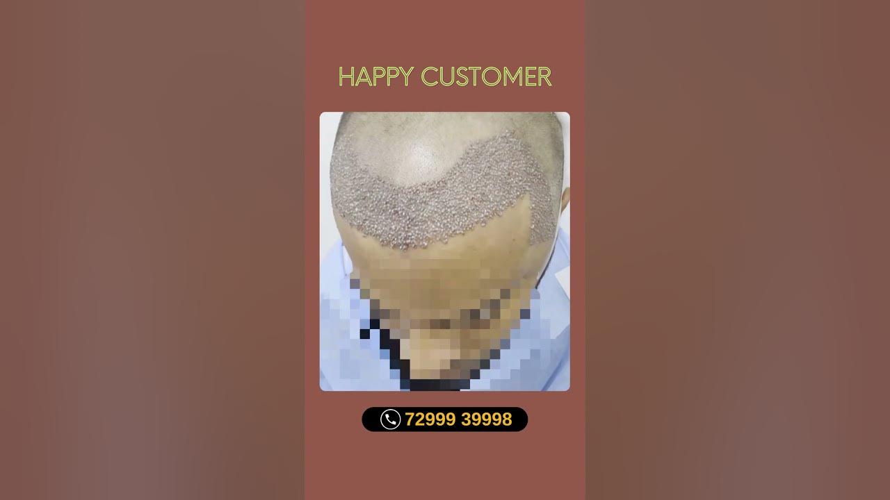 fue-hair-transplant-near-me-bio-fue-hair-transplant-recovery-la-hns