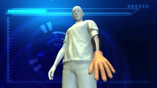 Mind-controlled prosthetic arm: new procedure allows patients to use advanced robotic arm