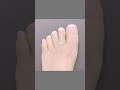 VISUAL BALANCING SURGERY❤️#toetuck #brachymetatarsiasurgery #toeshorteningsurgery #cosmeticsurgery thumbnail