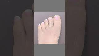 Download Lagu VISUAL BALANCING SURGERY❤️#toetuck #brachymetatarsiasurgery #toeshorteningsurgery #cosmeticsurgery MP3