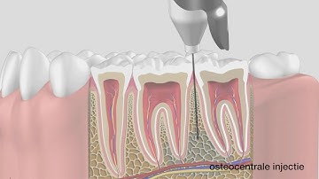 Hoe werkt de QuickSleeper? (schematische uitleg)