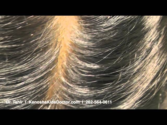 What Lice And Their Eggs Look Like - thptnganamst.edu.vn