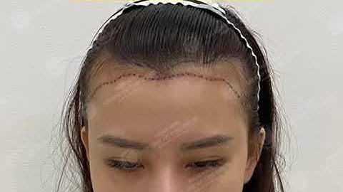Cấy 2300 nang tóc và cái kết sau 3 tháng | After 3 months of hair transplant