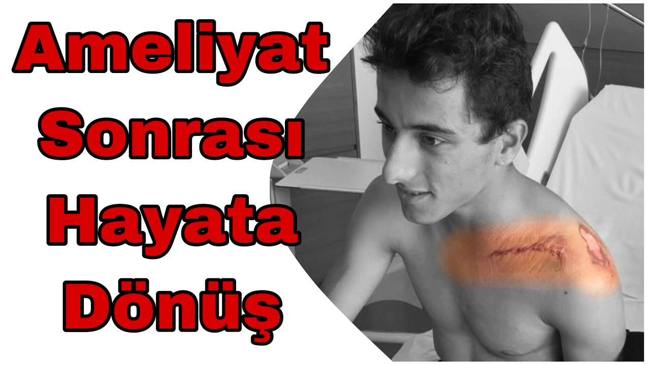 Ameliyattan 20 gün sonra || Fizyoterapi || Köprücük Kemiği Kırığı || #