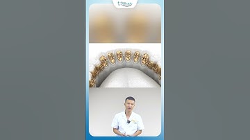 Niềng Răng Mắc Cài Mặt Lưỡi | Bác Sĩ Yên