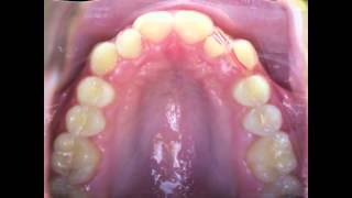 Upper Crooked Teeth Time Lapse Video Kyger Orthodontics