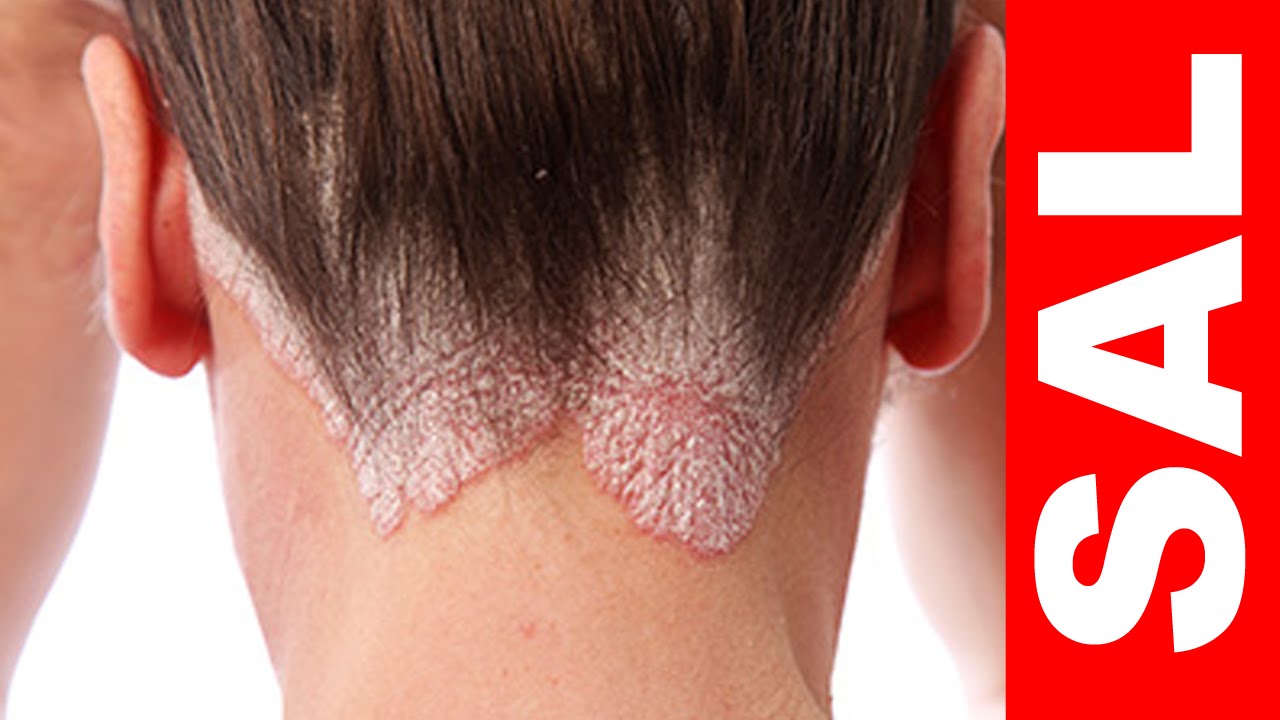 Cómo tratar la psoriasis del cuero cabelludo Cómo tratar la psoriasis del cuero cabelludo