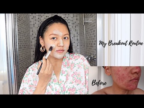 My Acne/Rosacea Breakout Routine ⎜Very Effective, Budget Friendly & Simple Routine