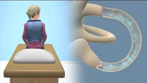 Epley Maneuver to Treat BPPV Vertigo