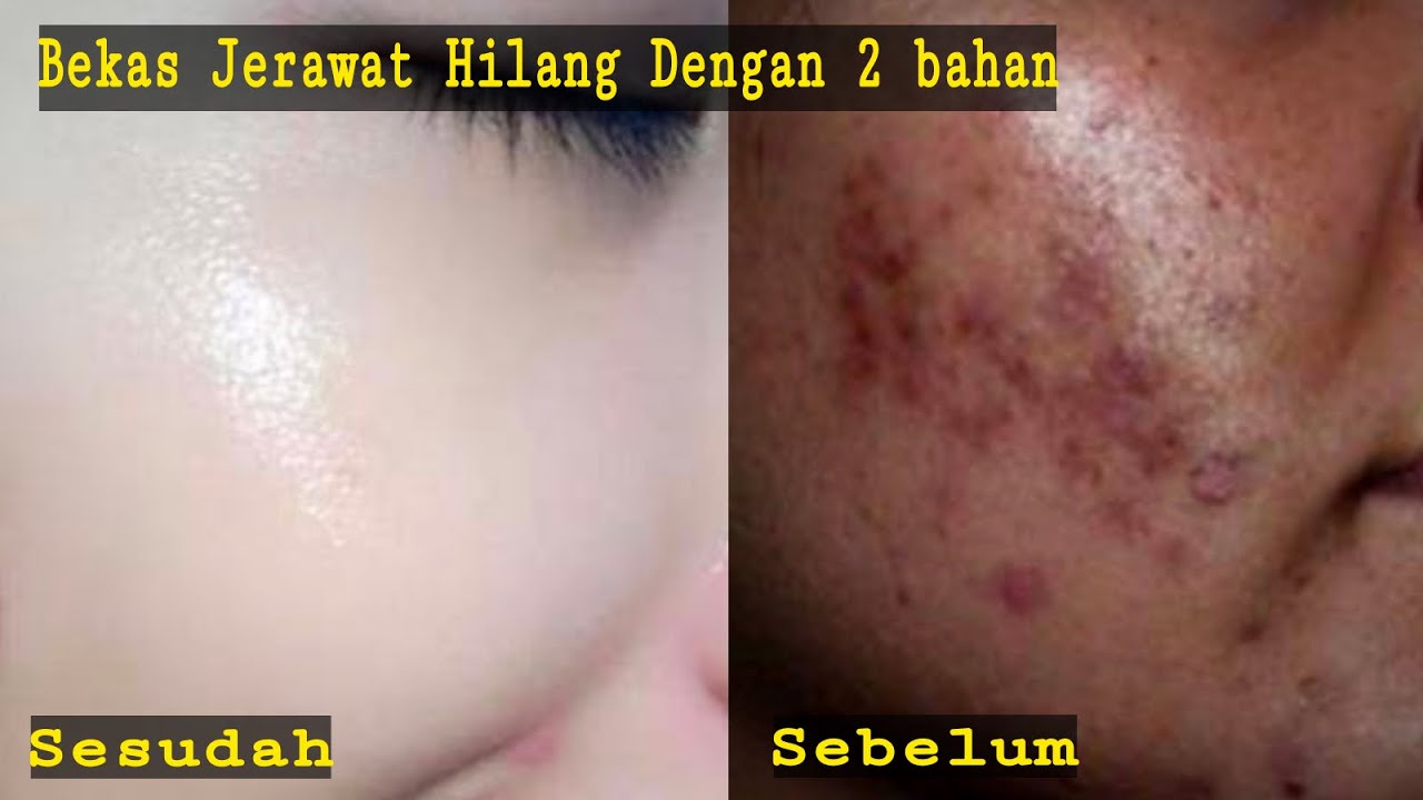 Cara Menghilangkan FLEK HITAM dengan 2 Bahan Saja 