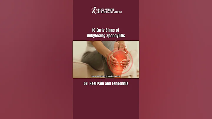 PART 8 | 10 Early Signs of Ankylosing Spondylitis You Shouldn’t Ignore!