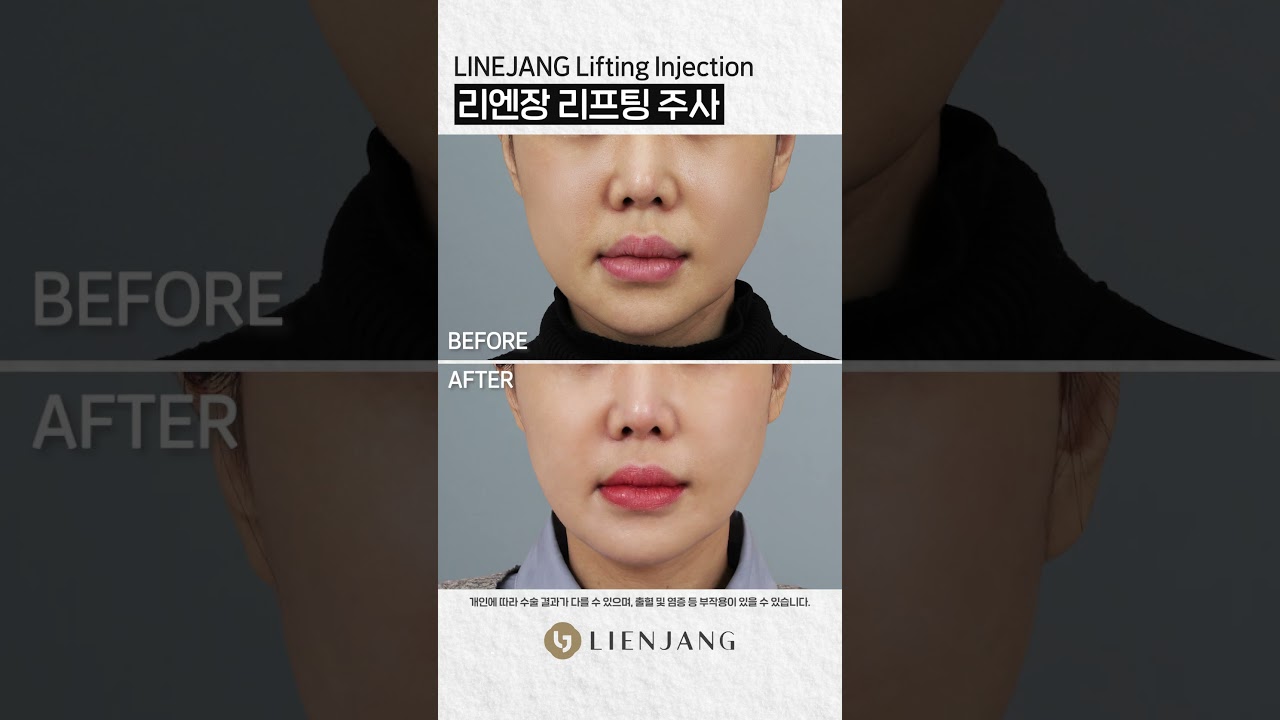 [Риэнжанг гоо сайхны эмнэлэг] Лифтинг #шортс #арьсарчилгаа #лифтингийнүрдүн #солонгос