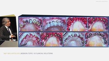 Immediate Loading of the Edentulous Patient: A Precise Protocol