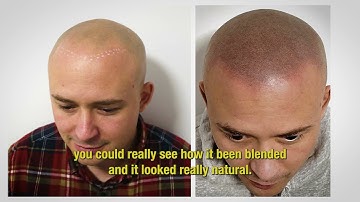 Dom gets his hairline back with scalp Micropigmentation. SMP process video, real results that last.