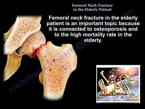 Video: Fracture Of The Femoral Neck In The Elderly