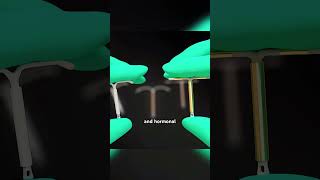 How Iuds Work? Intrauterine Device 3D Animation