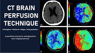 CT Brain Perfusion (CTP) | Complete Tutorial for Radiographers |CBF, CBV, MTT, Tmax, Core & Penumbra