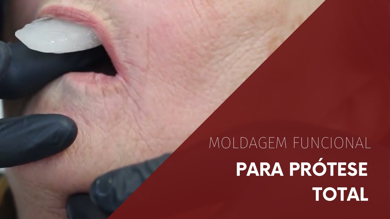 Moldagem Funcional para Prótese Total