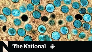 Monkeypox cases continue to rise in Canada