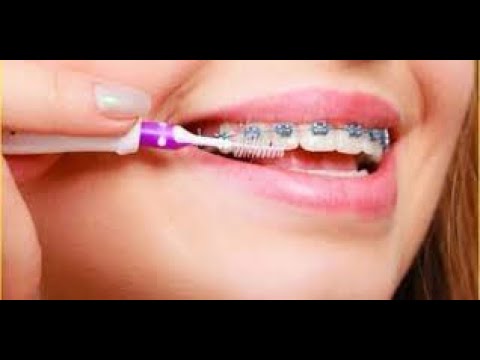 تنظيف تقويم الاسنان فرشاه التقويم