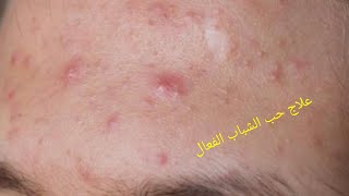 علاج حب الشباب/ بطريقه سهله وبسيطه بدون ادويه