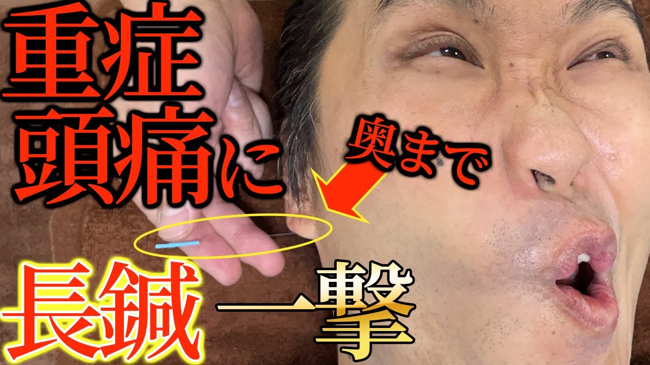 Acupuncture treatment for headaches] The acupuncture technique of
