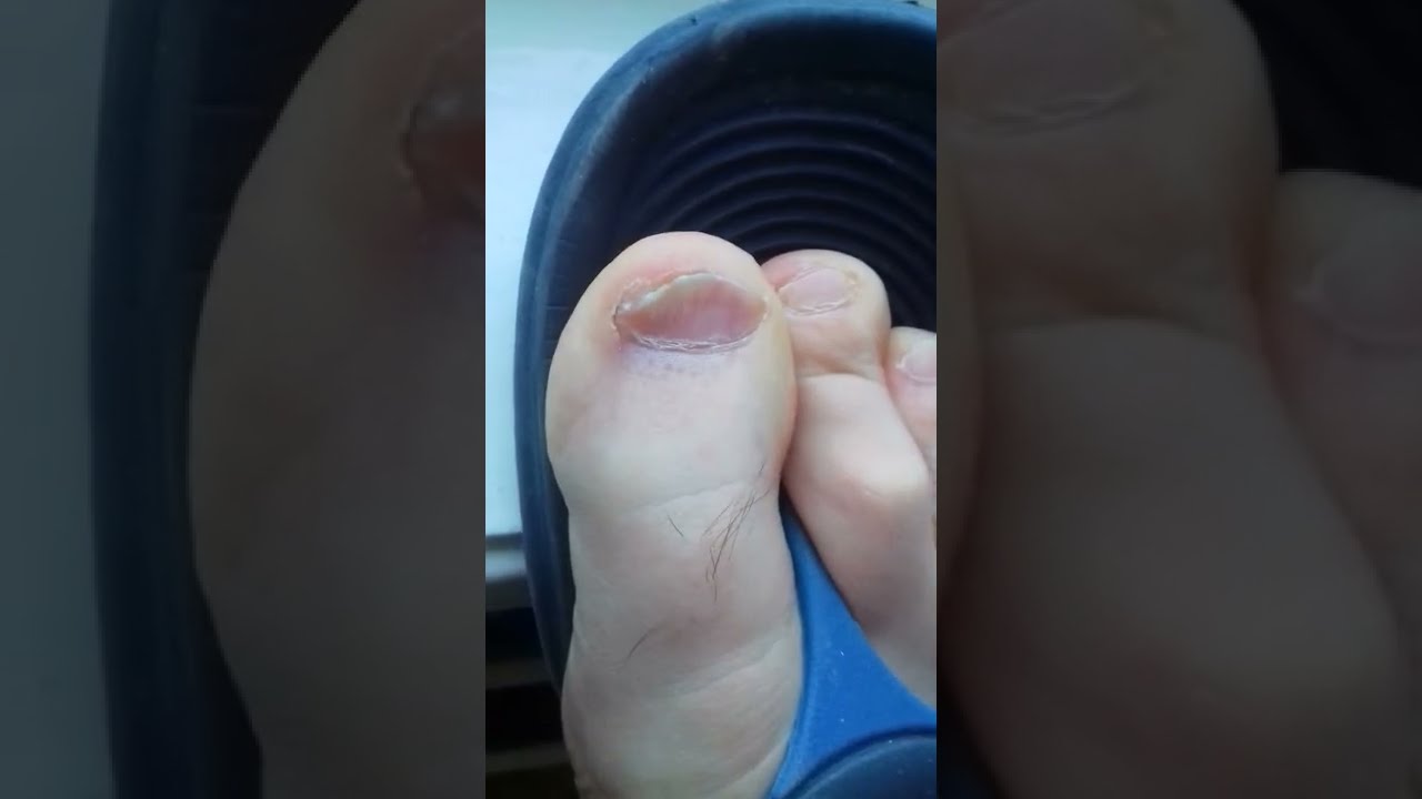 64 дня лечения от грибка ногтей капсулы итразол