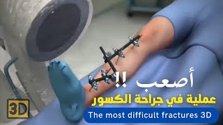 عملية جراحة كسر عظم الساق 3D