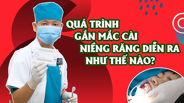 Cận Cảnh Toàn Bộ Quá Trình Gắn Mắc Cài Kim Loại Tự Buộc Tại Nha Khoa Việt Đức