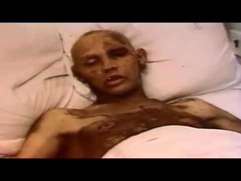 People affected by radiation during Chernobyl disaster. Radiation sickness. Part 2