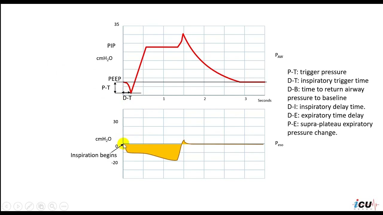 Analysis of Pressure Breath in Relation to Patient's Spontaneous Efforts