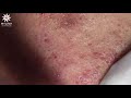 WARNING: A LOT OF BLACKHEADS (PART 2) | Lấy mụn ẩn dưới da, mụn đầu đen | My Linh