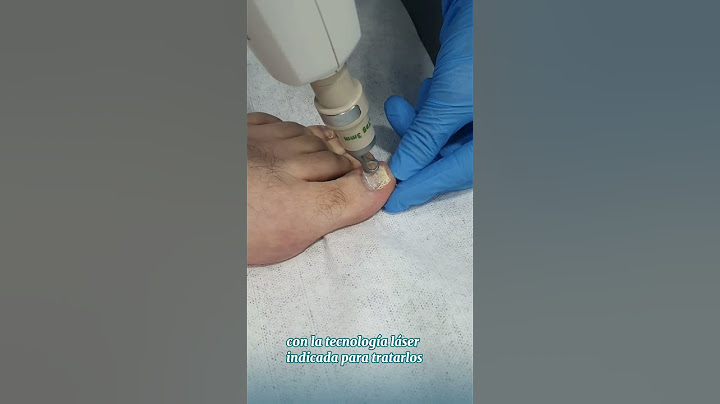 Tratamiento de Hongos en las Uñas con Laser - Dr. Angélica Domínguez Dermatóloga en bogotá