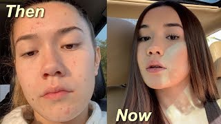 HOW I GOT RID OF MY ACNE IN TWO WEEKS! *not sponsored