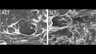 Selective Laser Trabeculoplasty: Tips and Tricks (Malik Y. Kahook, MD)