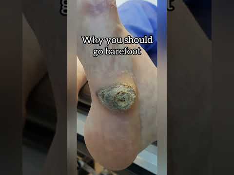 Why you should walk barefoot ep 13 | Foot corns #shorts