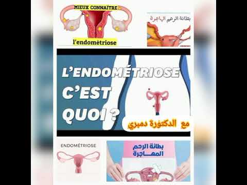 بطانة الرحم المهاجرة حديث عن  مع الحكيمة دمبري طبيبة مختصة في أمراض النساء