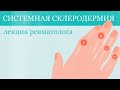 Системная склеродермия: лекция ревматолога