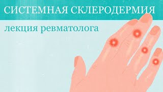 Системная склеродермия: лекция ревматолога