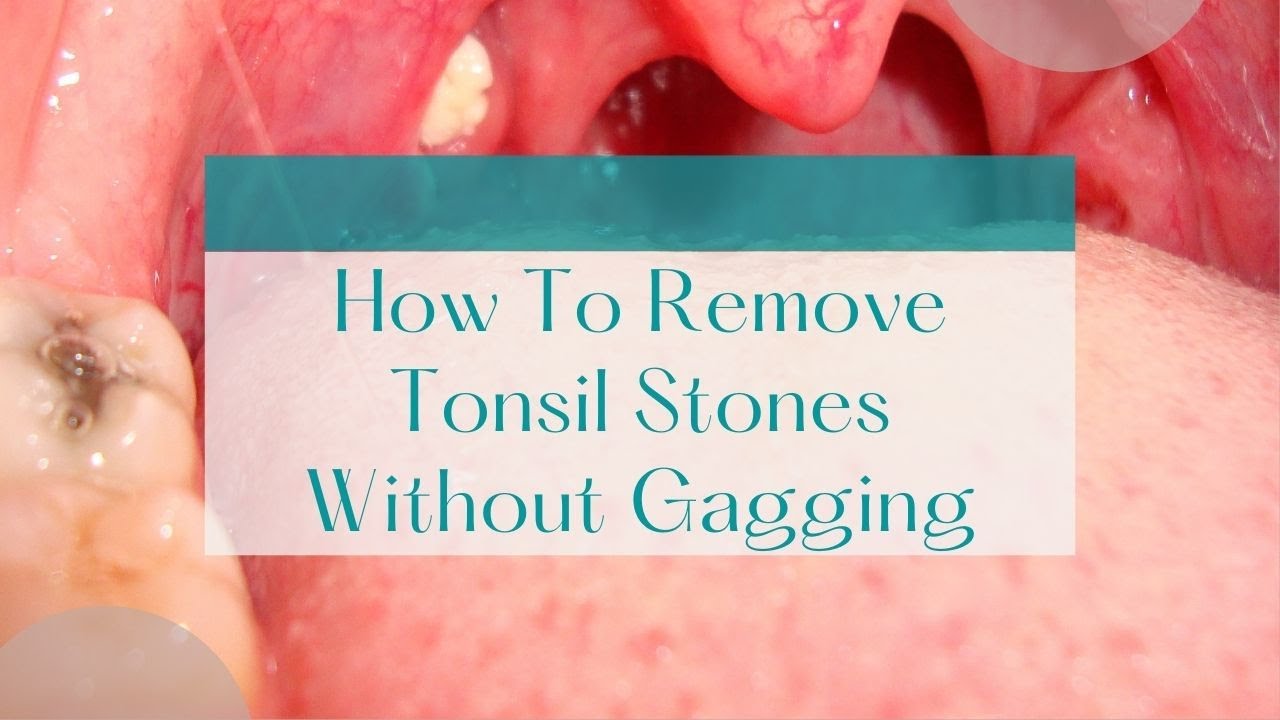 How To Remove Tonsil Stones Without Gagging Fast Tonsil Stones Cure