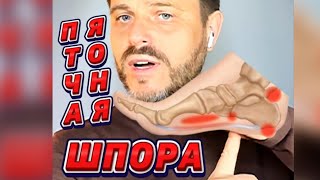 Пяточная шпора. подошвенный фасциит.