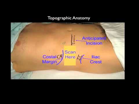 Frontiers  Ultrasound-guided transversus abdominis plane block as