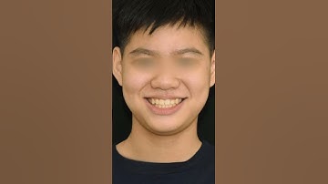 Răng móm – lệch lạc... và cú lột xác sau niềng khiến ai cũng sốc! #shorts #chinhnha #niengrang